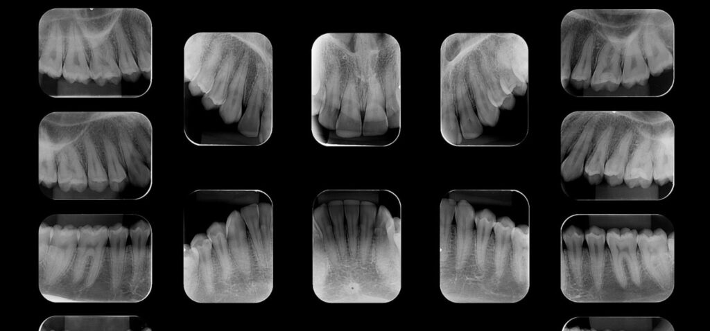 Periapical de Boca Toda Periapical de Boca Toda